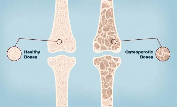 Illustration of bone health and the honeycomb structure of healthy bones